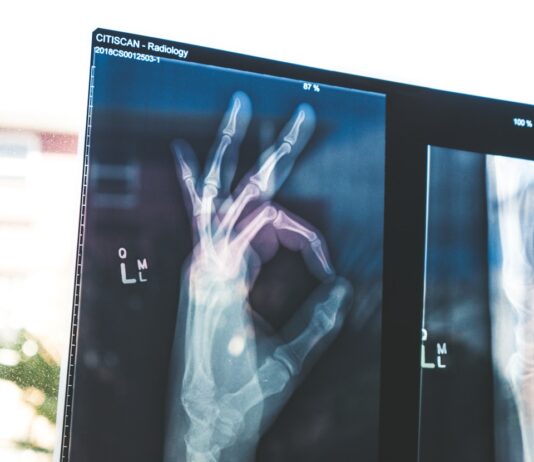 골다공증 예방, 튼튼한 뼈 건강을 위한 생활 속 실천법 citiscan result hand ok